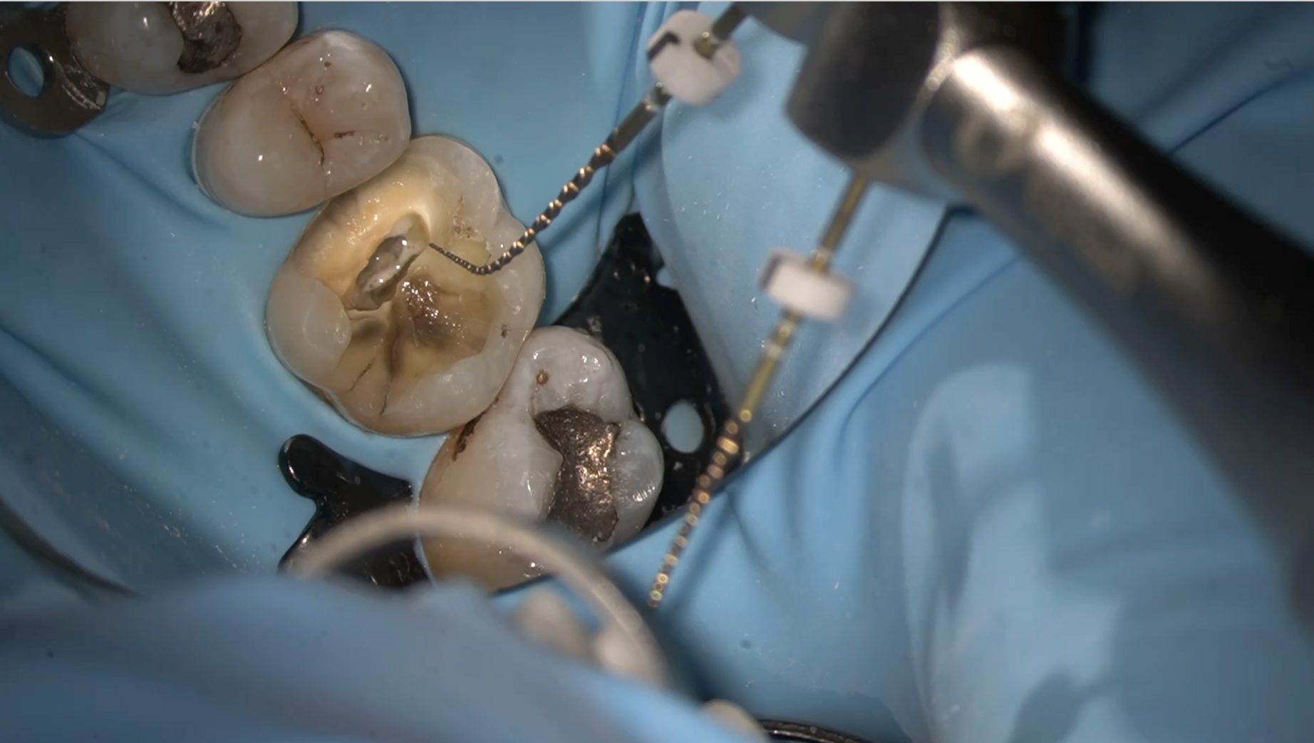Tooth with probe
